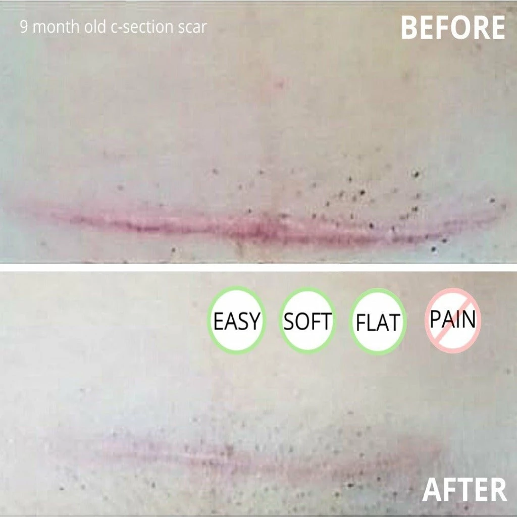 Bebelephant Award-winning CicaLux Energised Scar Care For Old And New Scars 5 Bebelephant Award-winning CicaLux Energised Scar Care For Old And New Scars