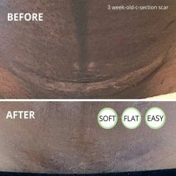 Bebelephant Award-winning CicaLux Energised Scar Care For Old And New Scars 13 Bebelephant Award-winning CicaLux Energised Scar Care For Old And New Scars