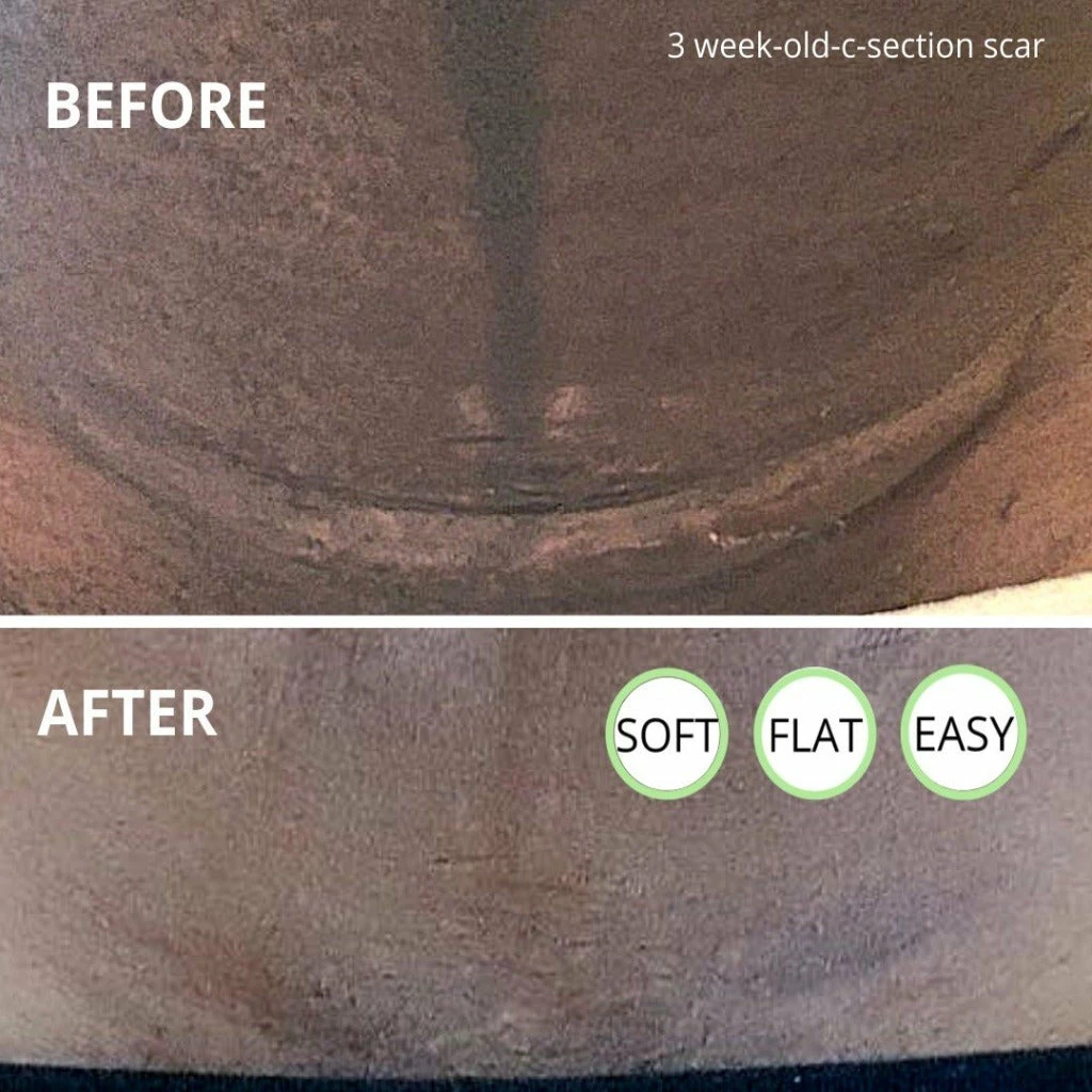 Bebelephant Award-winning CicaLux Energised Scar Care For Old And New Scars 6 Bebelephant Award-winning CicaLux Energised Scar Care For Old And New Scars